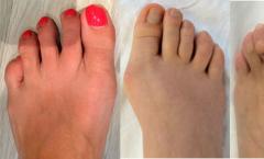 Bolesti zglobova - ravna stopala